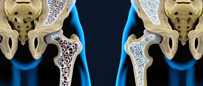 Cura osteoporose? Reverte a osteopenia?